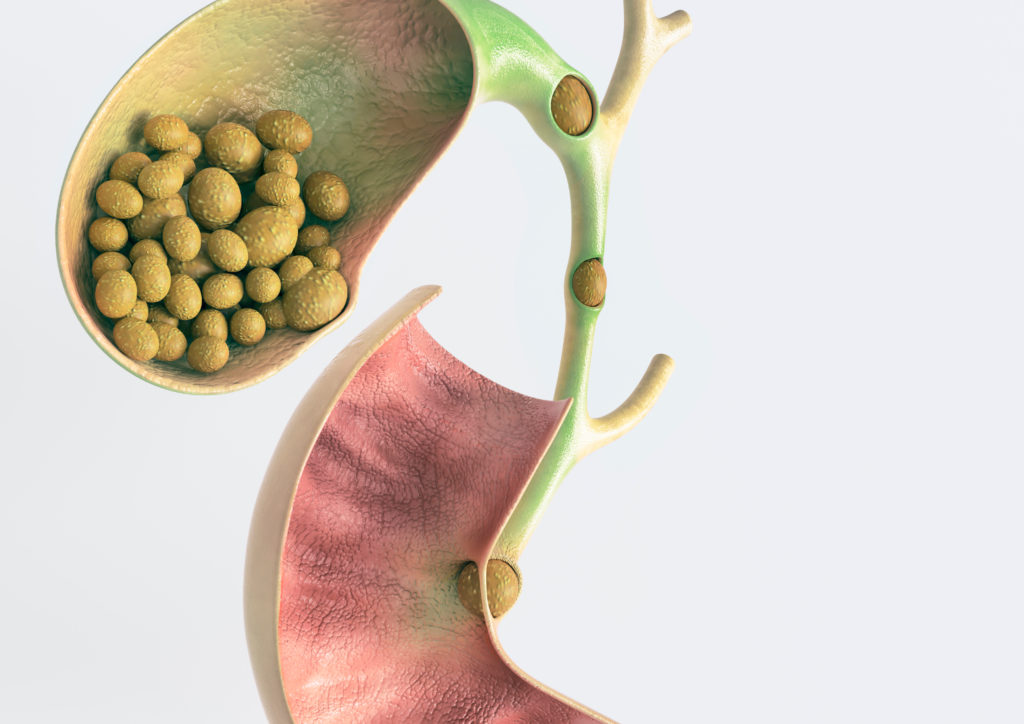 Gallstone Medicosnext