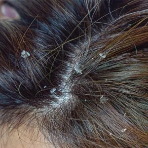 dry scalp dandruff