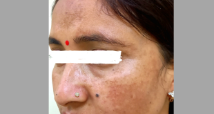 melasma