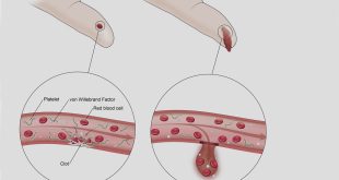 Von Willebrand Disease Illustration