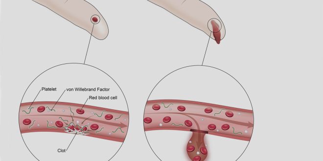 Von Willebrand Disease Illustration