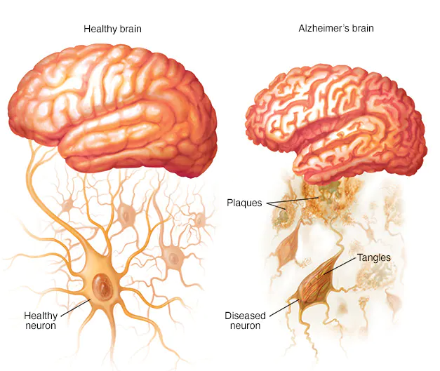 Alzheimer's disease Alzheimer's disease, a progressive and often life rendering disease, is the most common cause of dementia. It usually occurs in patients older than 65 years of years and its incidence